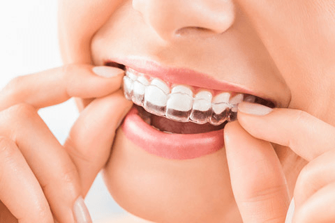 Clear Aligner & Invisalign